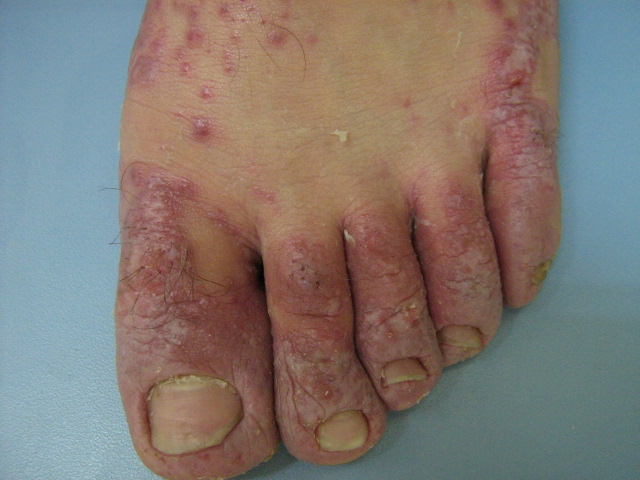 Keratosis Lichenoides Chronica (Nekam disease, lichen 