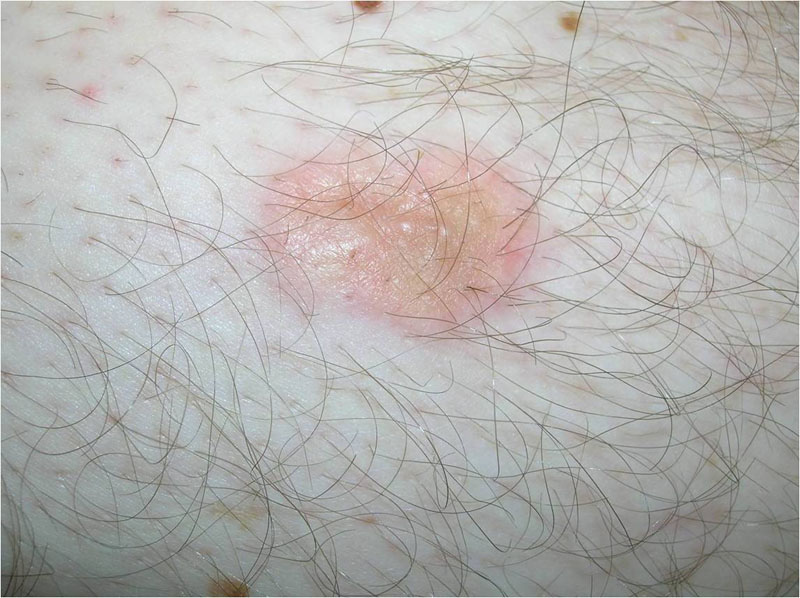 Leiomyosarcoma - The Clinical Advisor