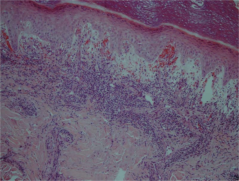 Chilblain Lupus (SLE pernio) - The Clinical Advisor