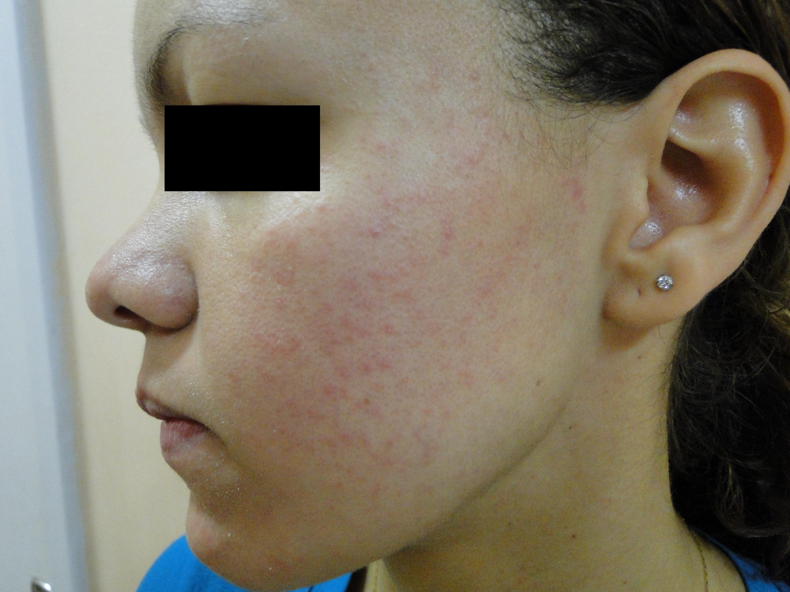 Majocchi’s Granuloma (Granuloma trichophyticum) The Clinical Advisor