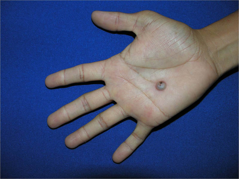 Michelin Tire Baby Syndrome (congenital multiple circumferential skin