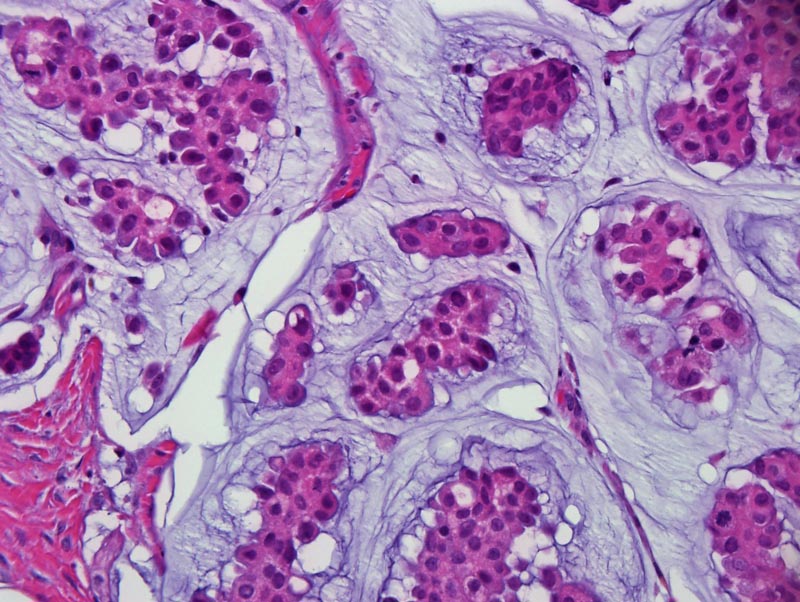 Mucinous Carcinoma - The Clinical Advisor