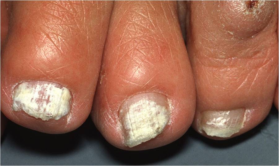 onychomycosis-tinea-unguium-nail-fungal-infection-the-clinical-advisor