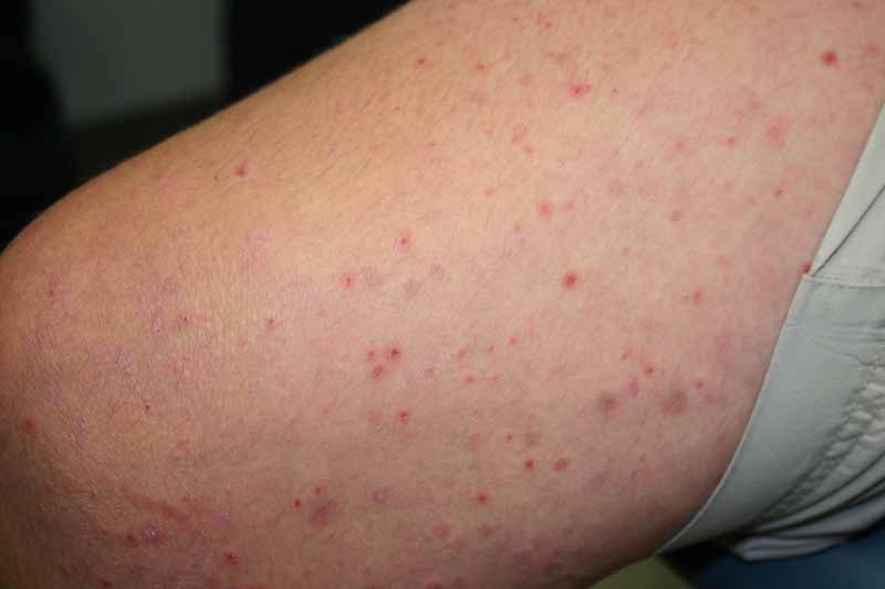 pityriasis-lichenoides-chronica-the-clinical-advisor