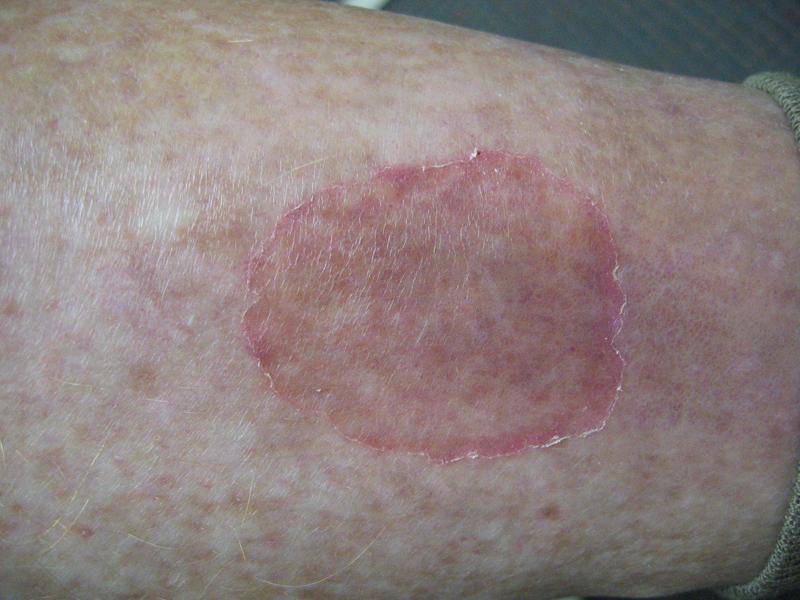 Porokeratosis (all variants) The Clinical Advisor