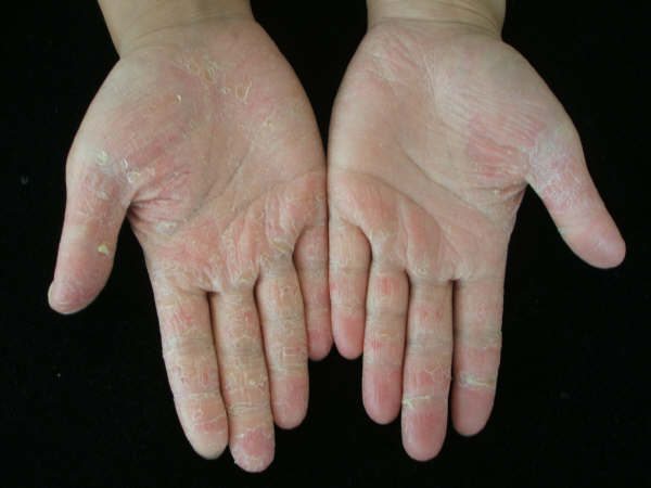 Progressive Symmetric Erythrokeratoderma (progressive Symmetric 