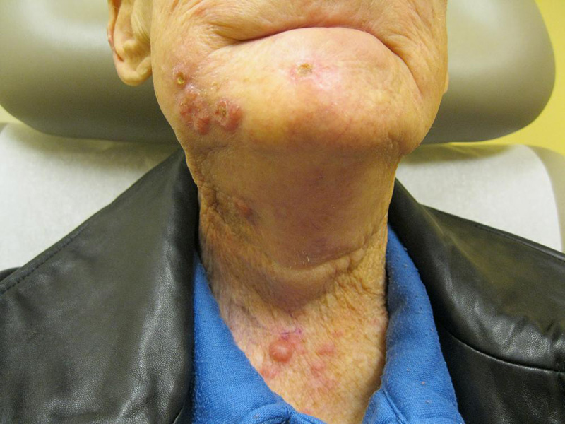 Radiation Dermatitis (radiodermatitis, radiation epidermitis, radiation