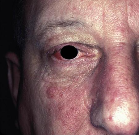 Rosacea - The Clinical Advisor