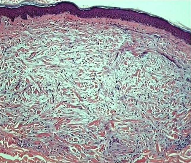 Scleromyxedema (generalized and sclerodermoid lichen myxedematosus ...