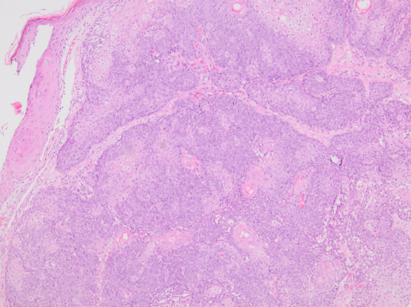Sebaceous Carcinoma (Sebaceous Gland Carcinoma, Sebaceous Cell