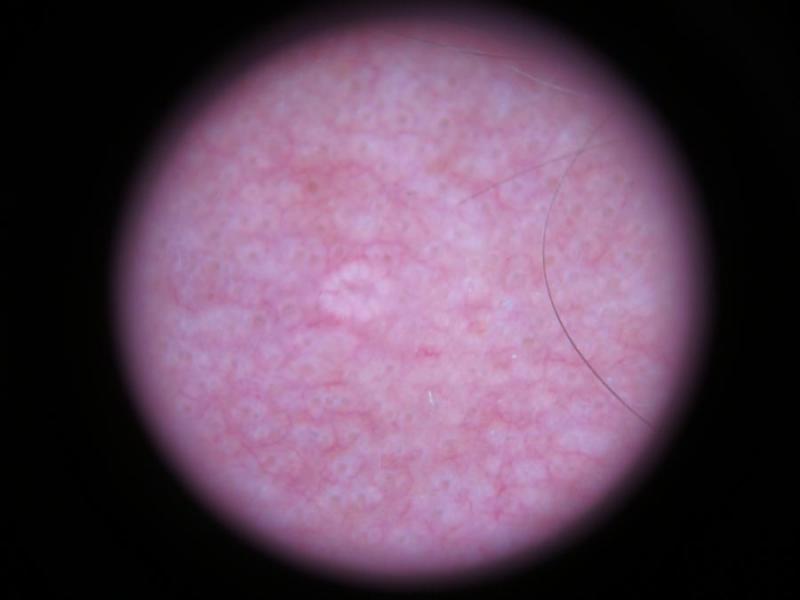 Sebaceous Gland Hyperplasia (Sebaceous Hyperplasia, Senile Sebaceous