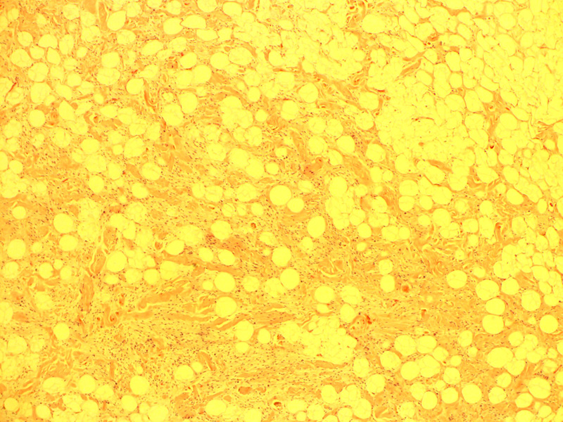 Spindle Cell Lipoma The Clinical Advisor