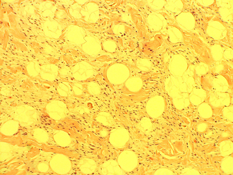 Spindle Cell Lipoma The Clinical Advisor