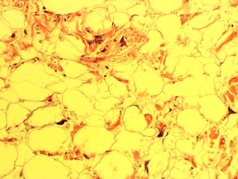 Spindle Cell Lipoma The Clinical Advisor