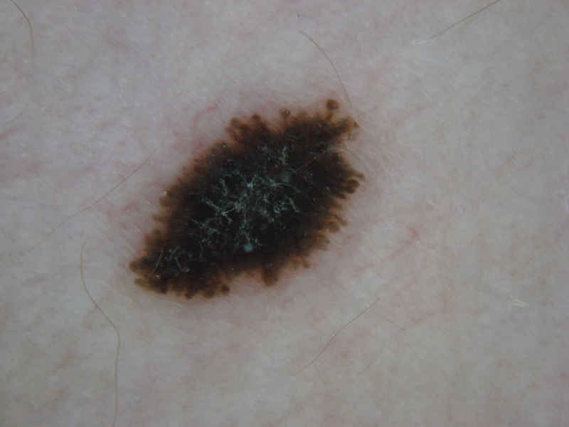 Spitz nevus - The Clinical Advisor