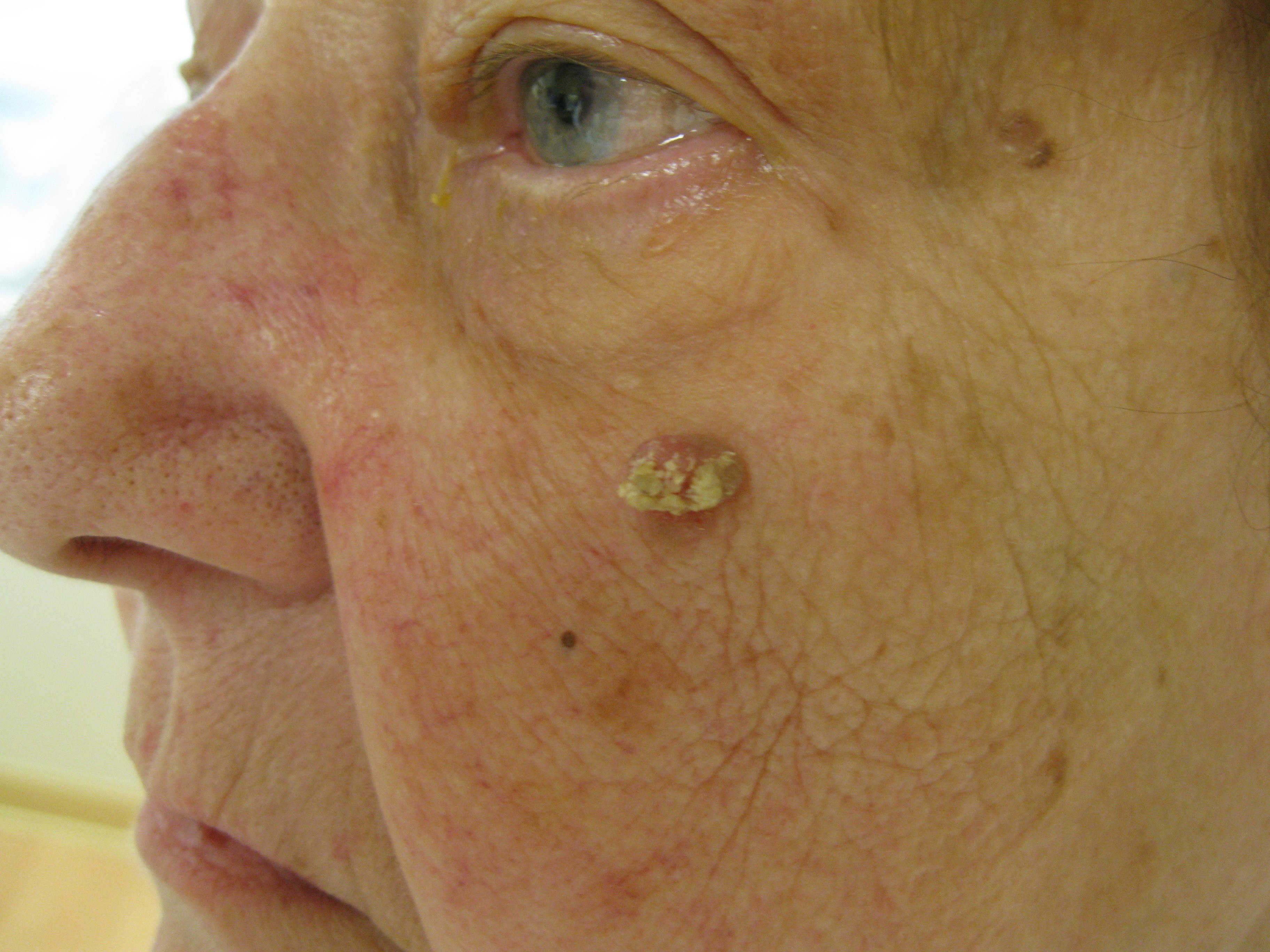 squamous-and-basal-cell-carcinoma-surgical-margins