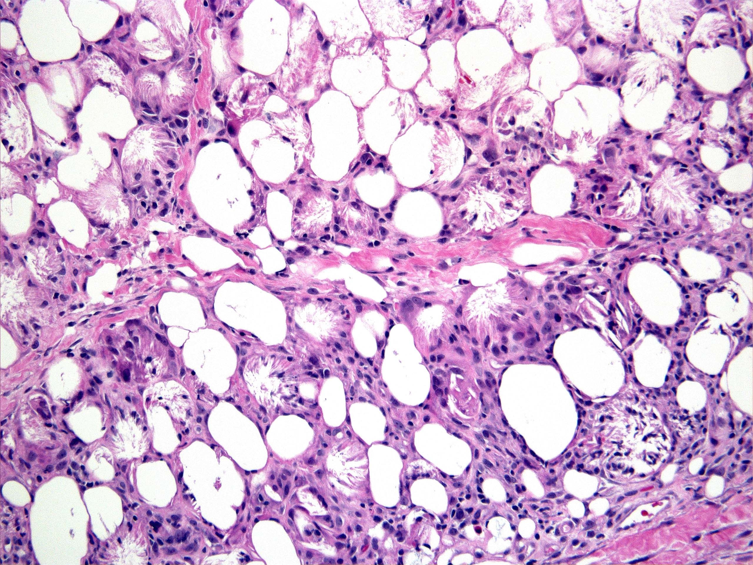Subcutaneous fat necrosis of the newborn The Clinical Advisor