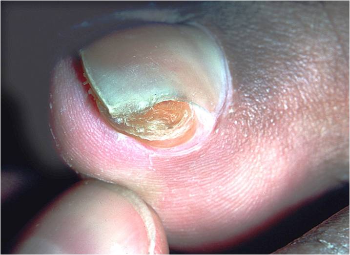 Subungual exostosis (Dupuytren's subungual exostosis, enchondroma