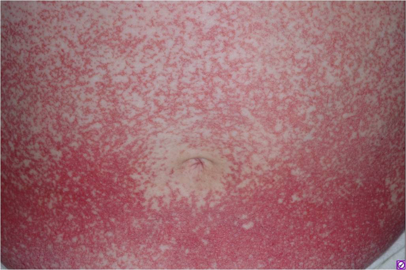 Telangiectasia (generalized essential telangiectasia) The Clinical