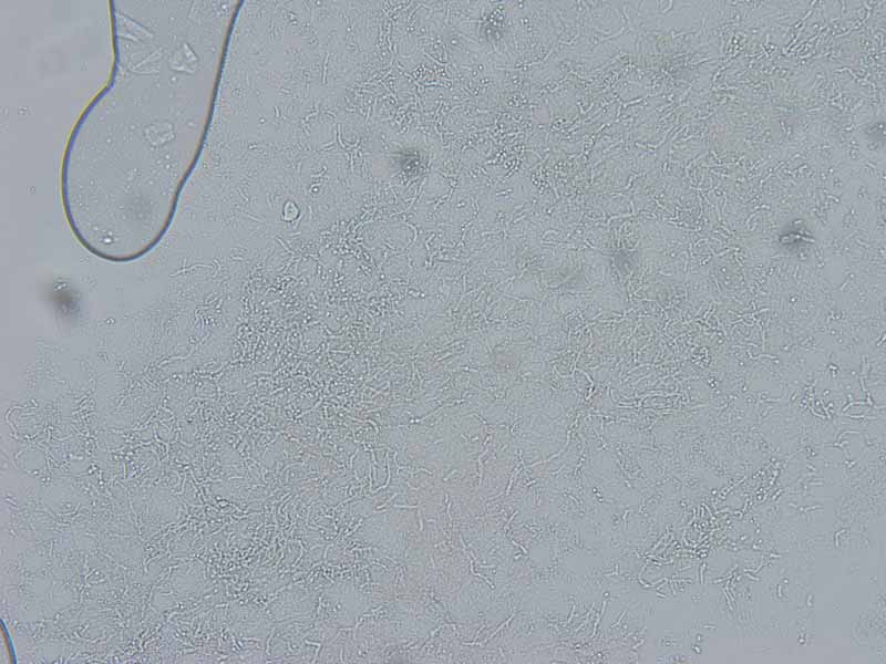 Tinea Versicolor (pityriasis versicolor) The Clinical Advisor