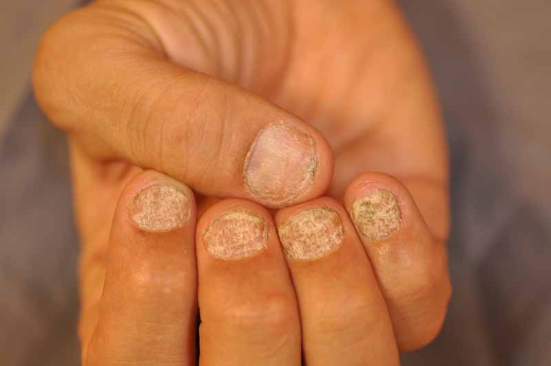 Trachyonychia (Rough Nails) - The Clinical Advisor