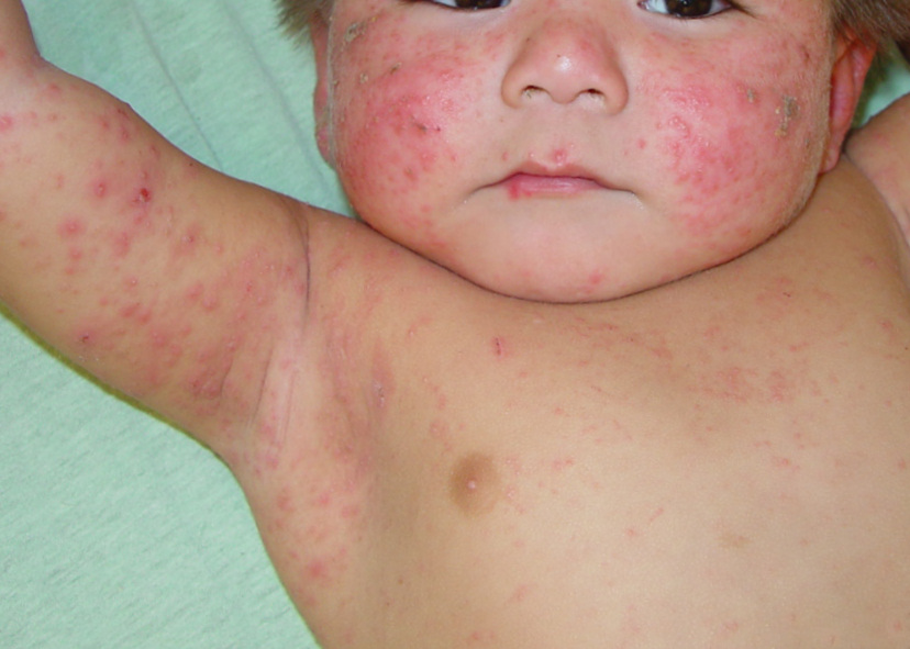 neonatal-acne-acne-neonatal-and-infantile-the-clinical-advisor