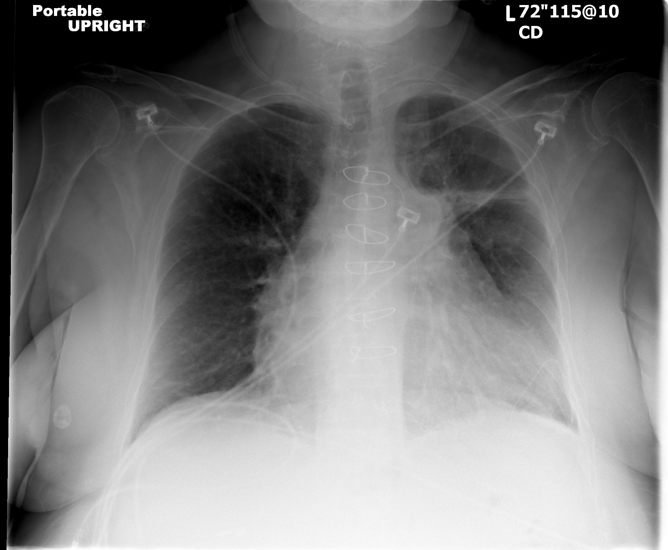 Radiation-Induced Lung Injury - The Clinical Advisor