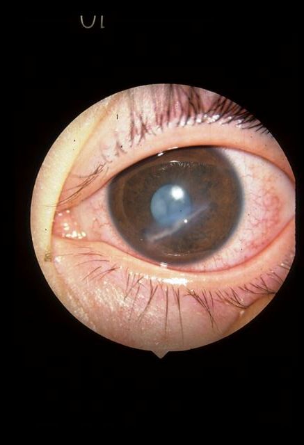 Partial Thickness Corneal Laceration