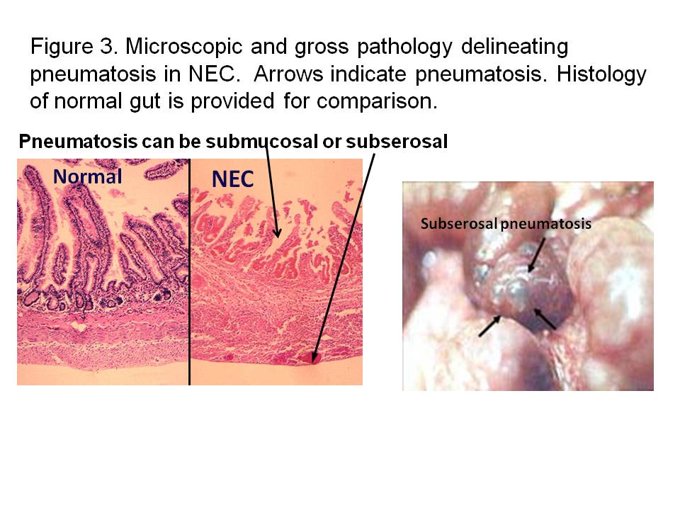 Necrotizing enterocolitis The Clinical Advisor
