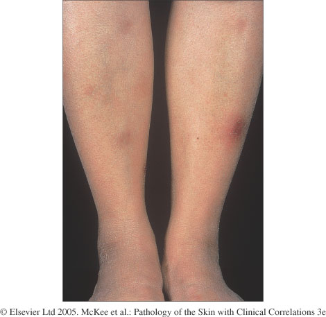 Erythema nodosum - The Clinical Advisor