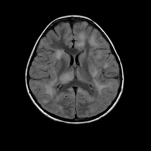 Multiple sclerosis - The Clinical Advisor