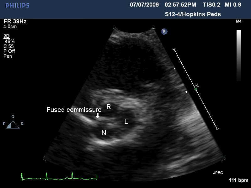 Aortic Stenosis - The Clinical Advisor