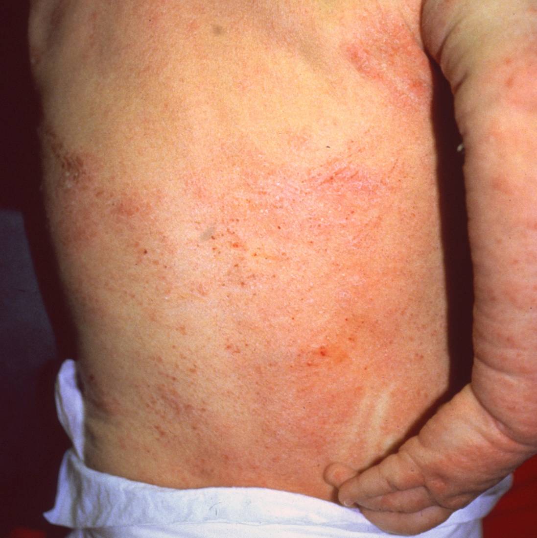 Dermatitis Nerviosa 