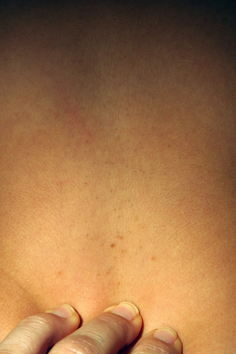 The dynamic natural skin care: vellus hair definition Eruptive vellus hair cyst - The Clinical Advisor