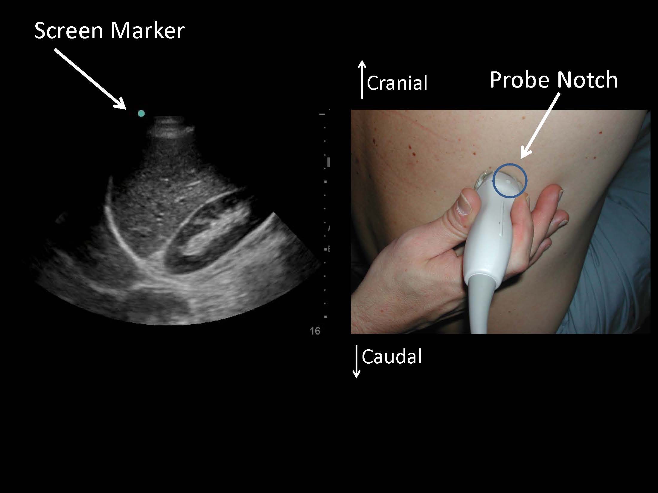 ultrasound pleural thoracic thoracentesis biopsy probe procedure orientation chest marker line patient pneumothorax pulmonary figure supine air