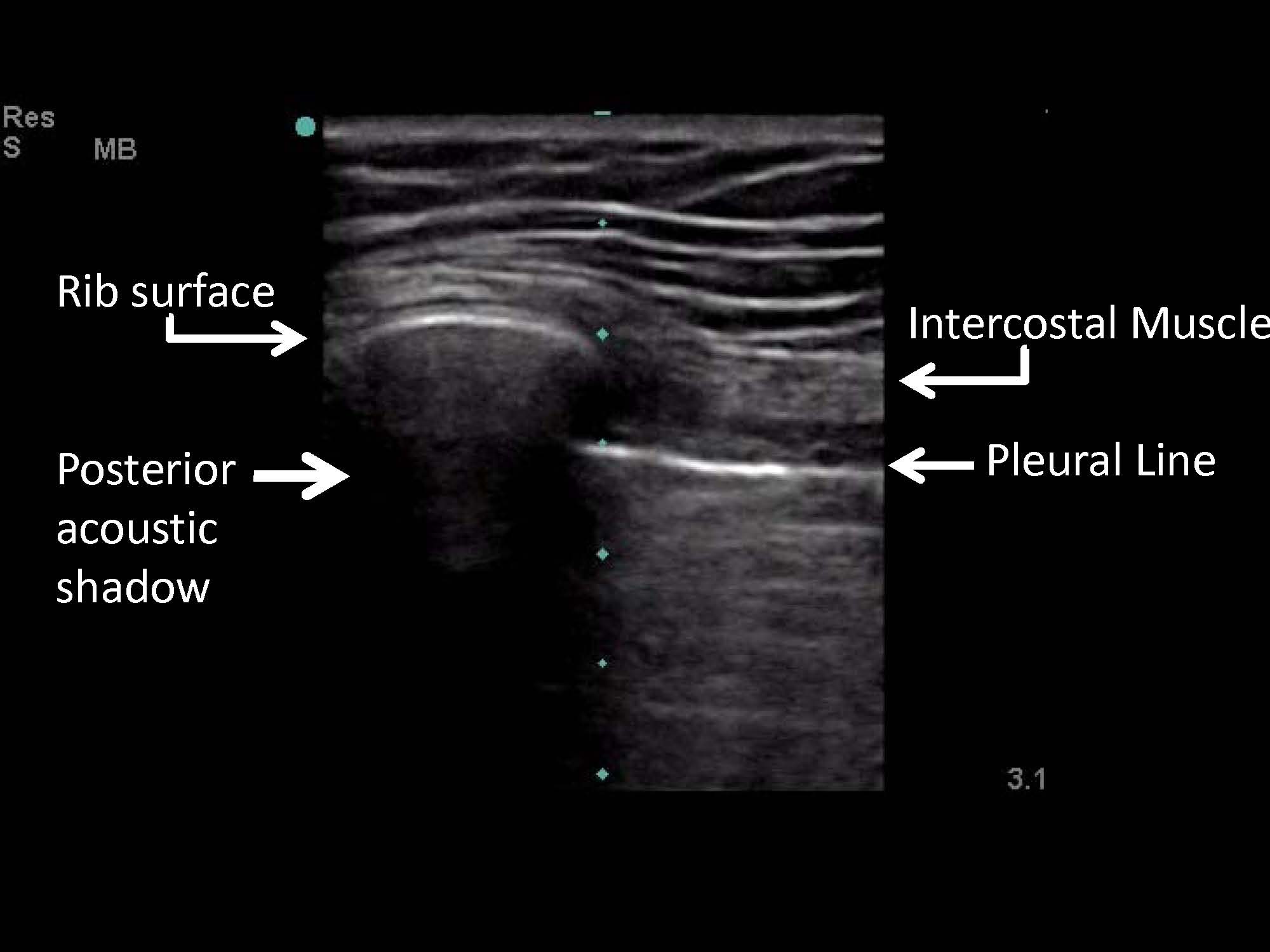 Thoracentesis, Pleural Biopsy, and Thoracic Ultrasound - The Clinical