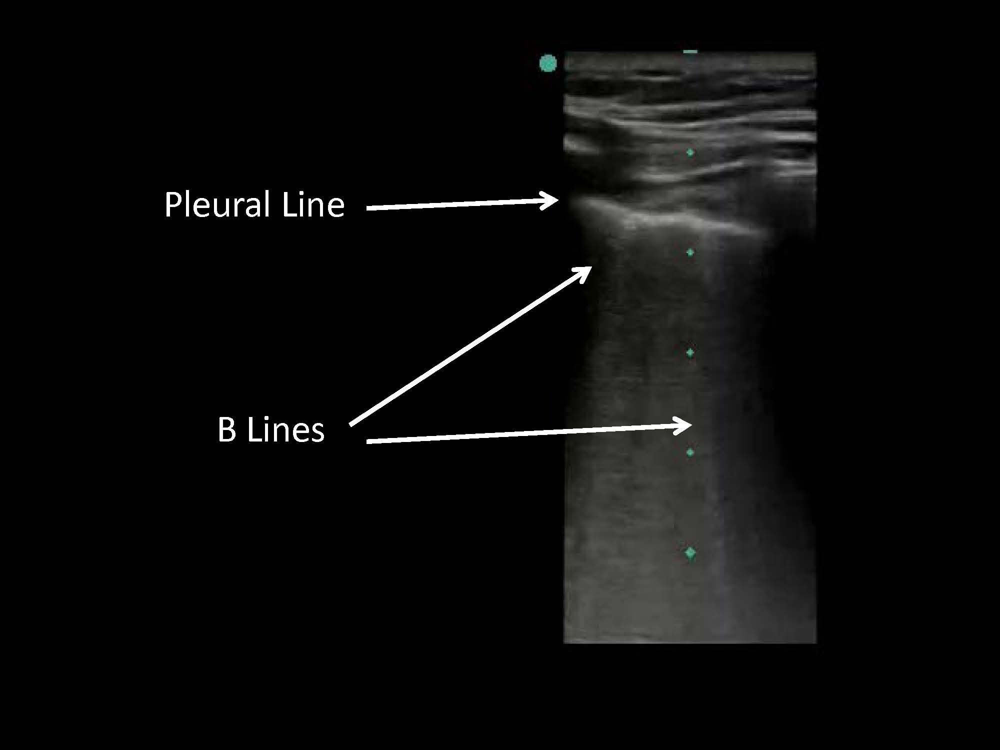 Thoracentesis, Pleural Biopsy, And Thoracic Ultrasound - The Clinical ...