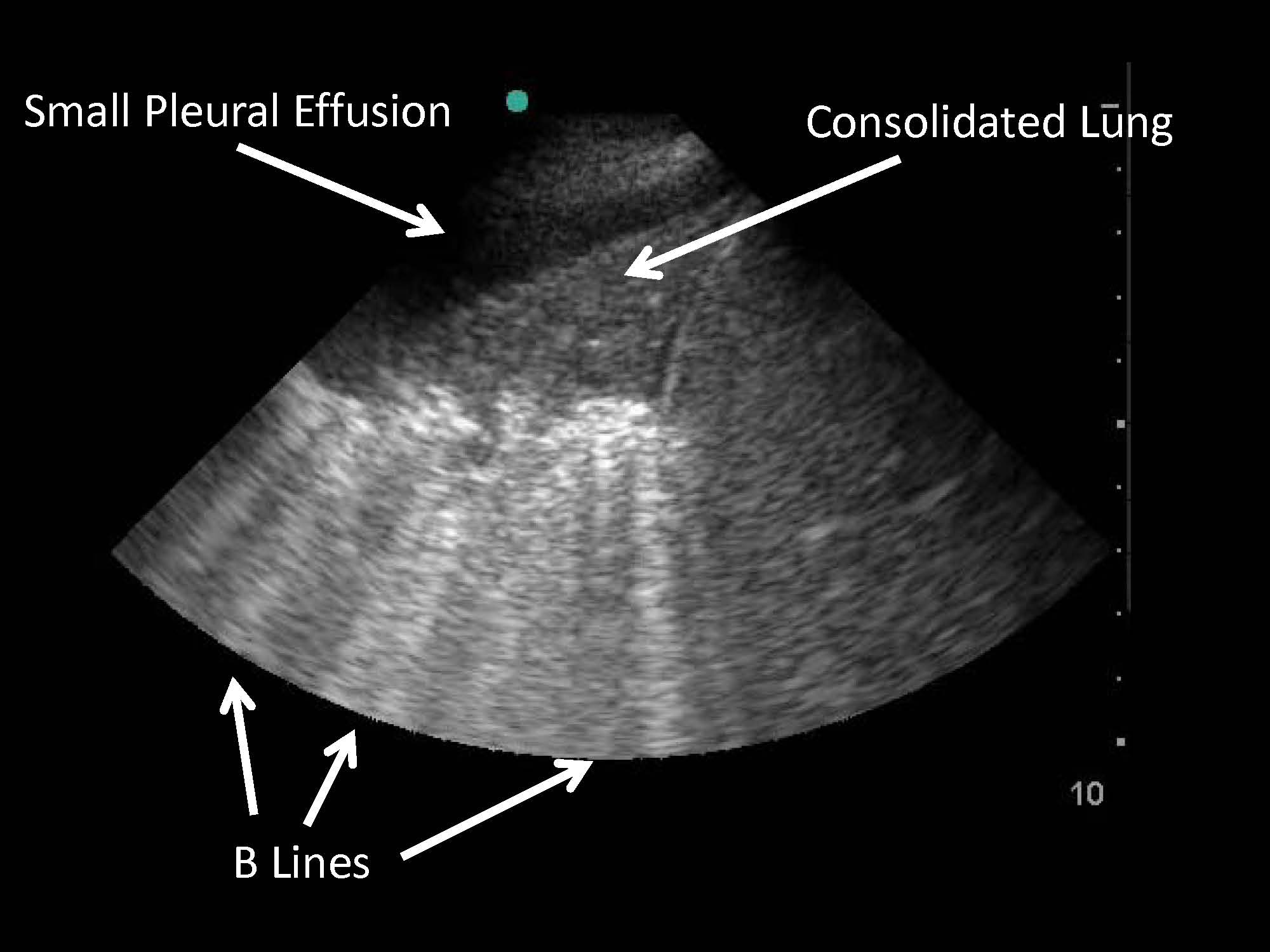 Thoracentesis, Pleural Biopsy, and Thoracic Ultrasound - The Clinical ...