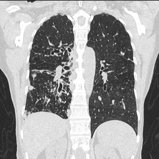 Bronchiectasis The Clinical Advisor