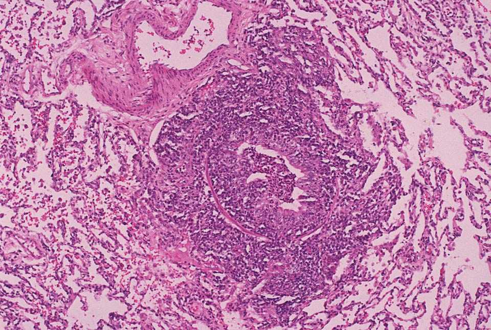 bronchiolitis-respiratory-bronchiolitis-acute-bronchiolitis