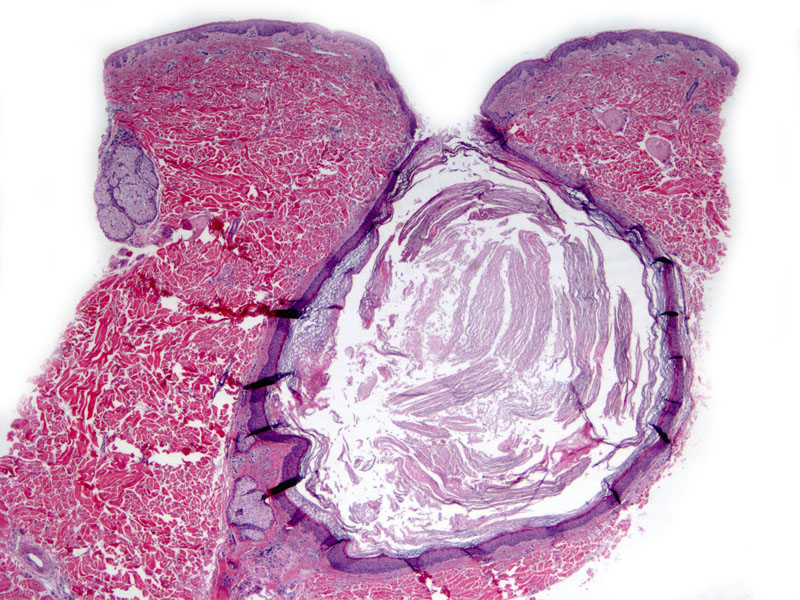 Epidermal (infundibular) cysts - The Clinical Advisor