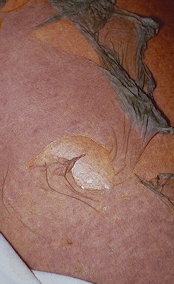Toxic Epidermal Necrolysis (TEN, Lyell's syndrome, Stevens-Johnson ...