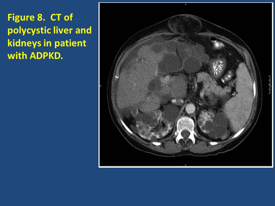 Gallstones and hepatic cysts - The Clinical Advisor
