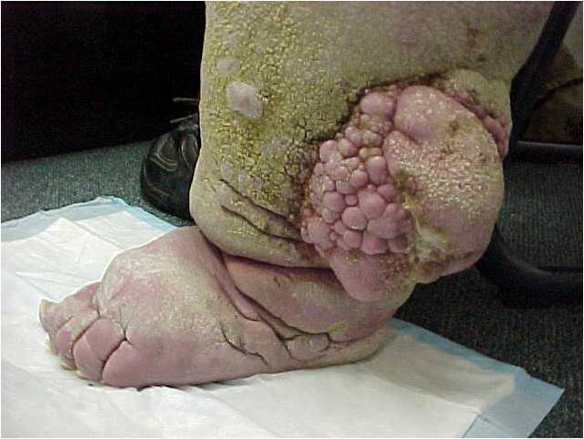 Lymphedema - The Clinical Advisor