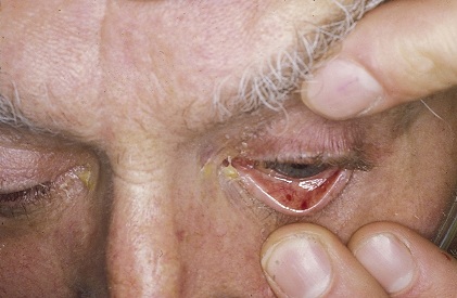 endocarditis petechiae eye