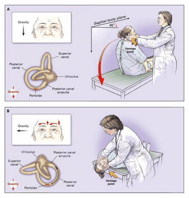 Benign paroxysmal positional vertigo (benign paroxysmal nystagmus ...