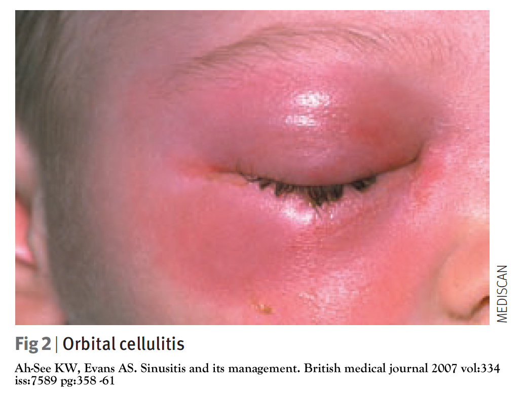 sinusitis-the-clinical-advisor