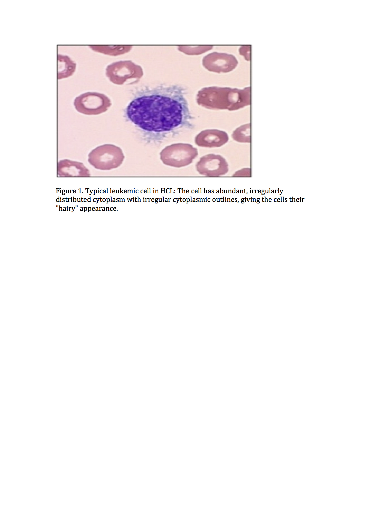 Hairy Cell Leukemia - The Clinical Advisor