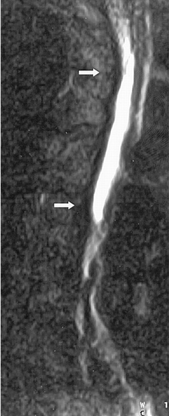 Spinal cord ischemia - The Clinical Advisor