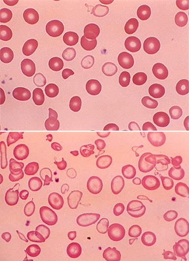 anemia with misshapen red blood cells